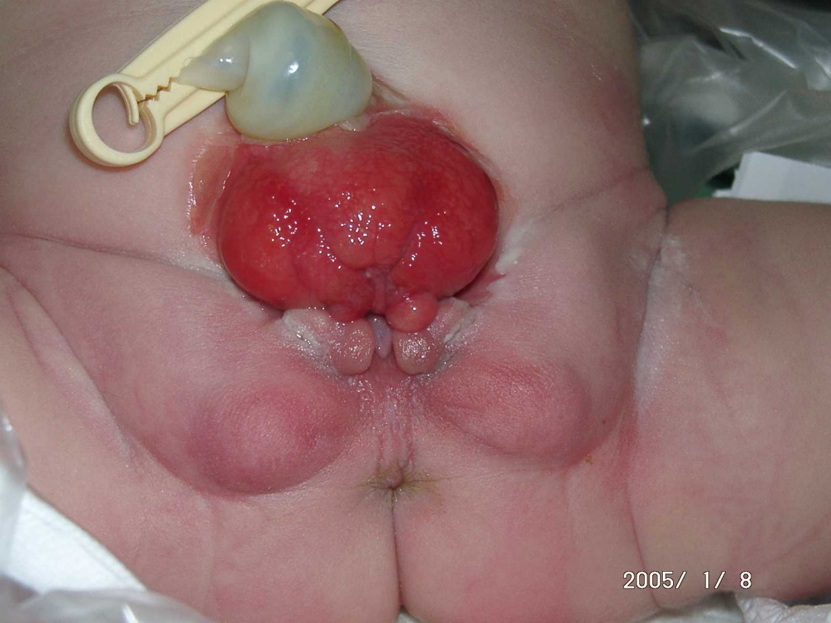 Bladder Exstrophy