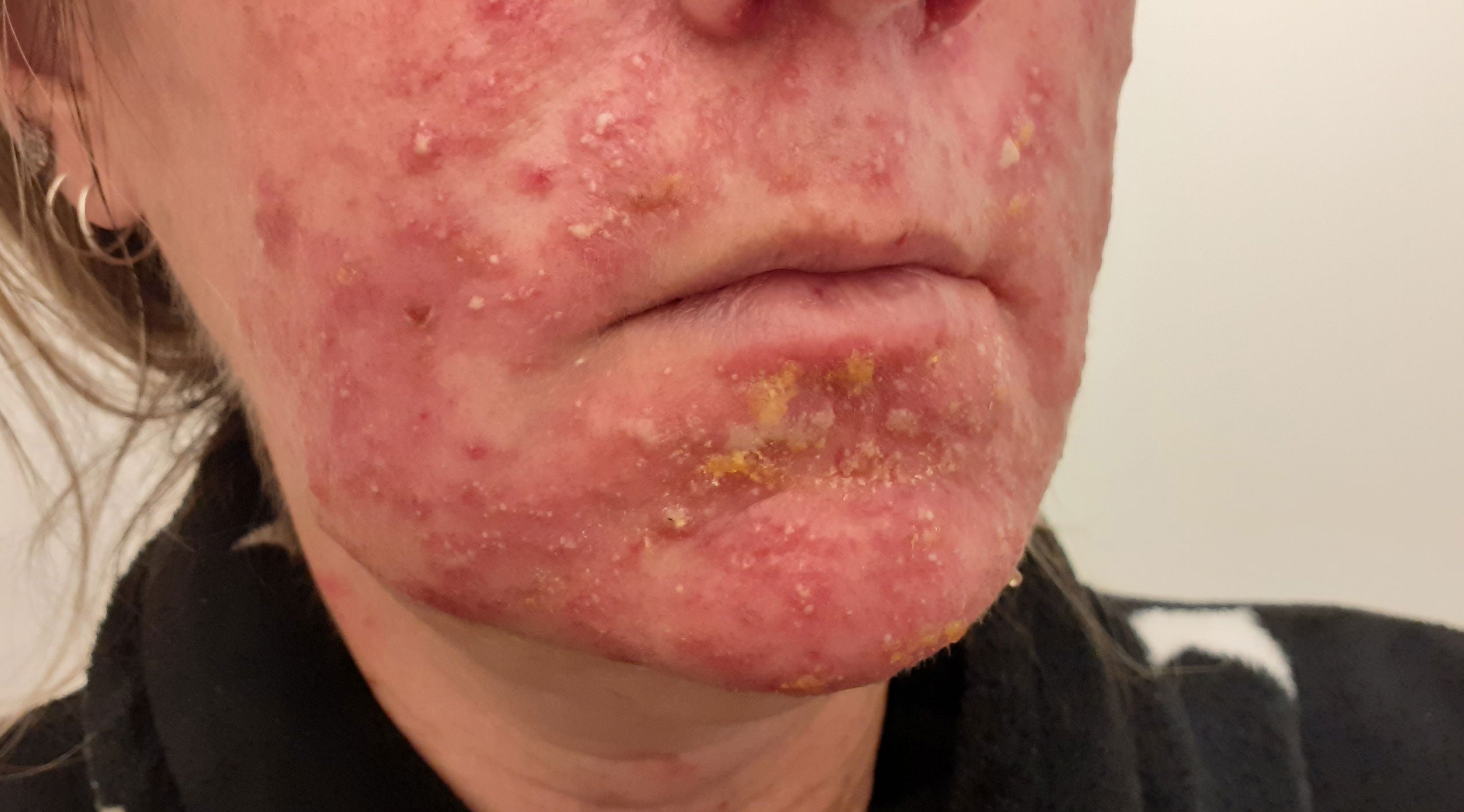 Pemphigus Foliaceus
