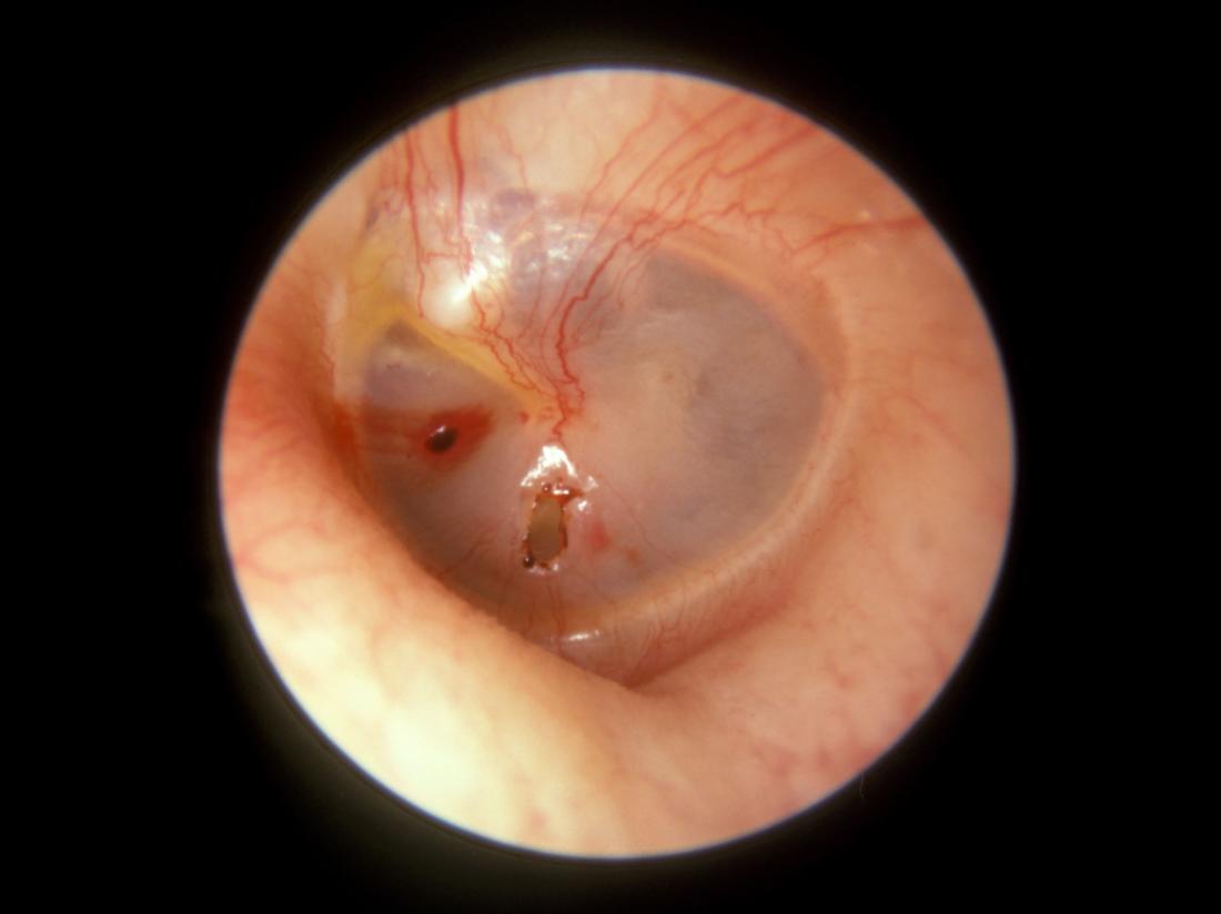 RUPTURED EARDRUM