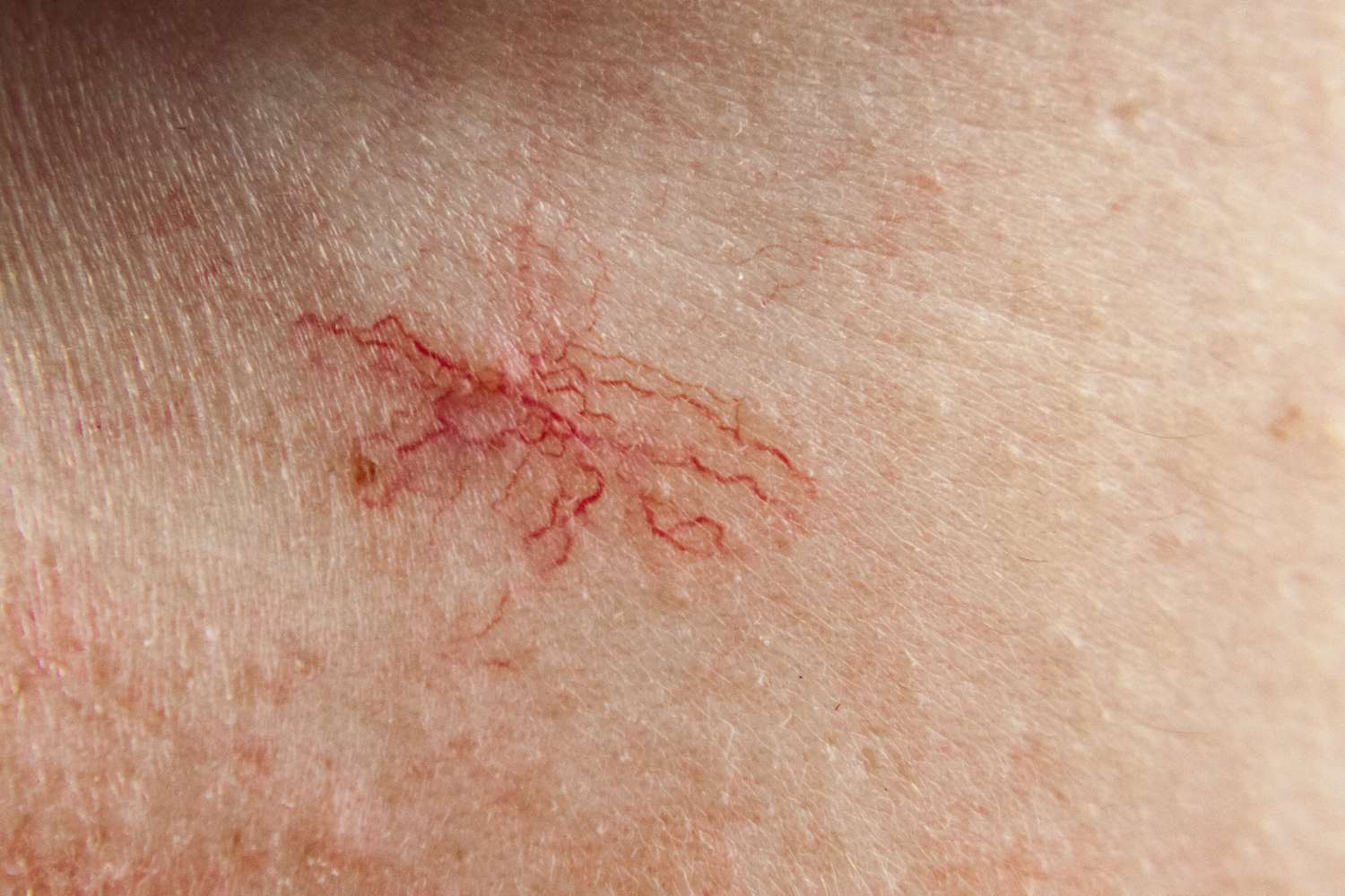 Spider Angioma