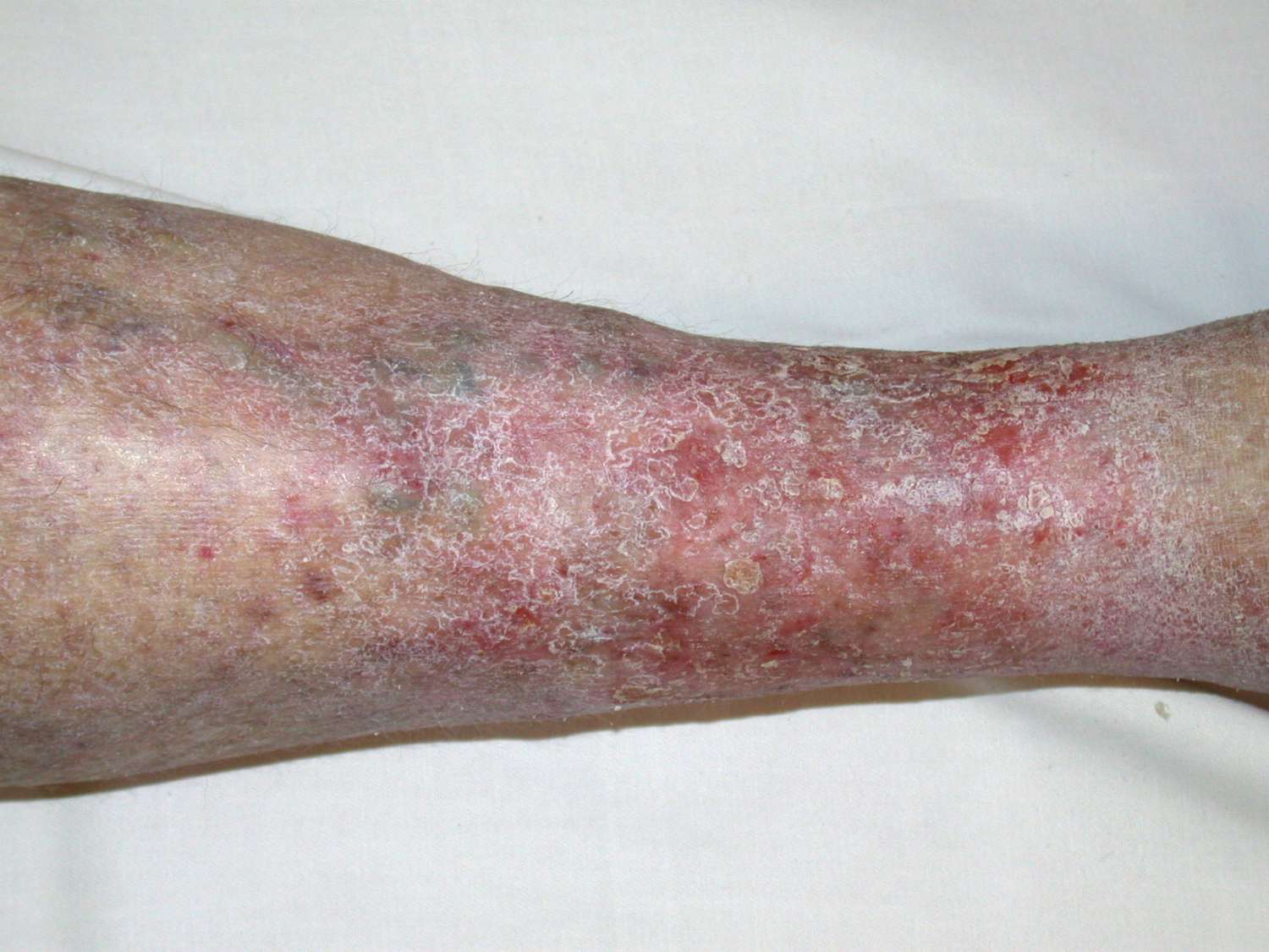 Stasis Dermatitis