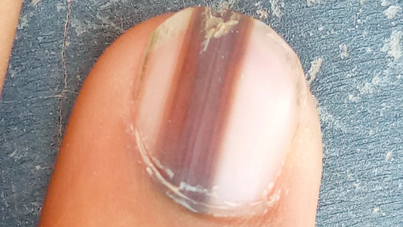 Subungual Melanoma