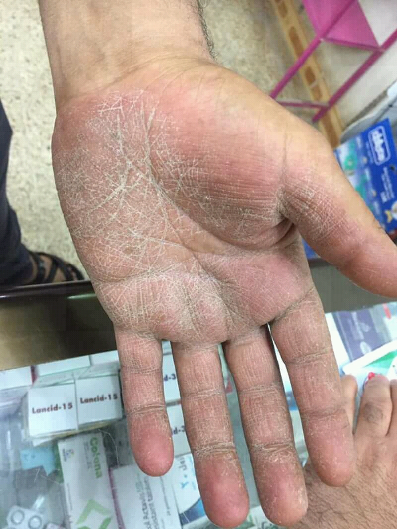 Tinea Manuum
