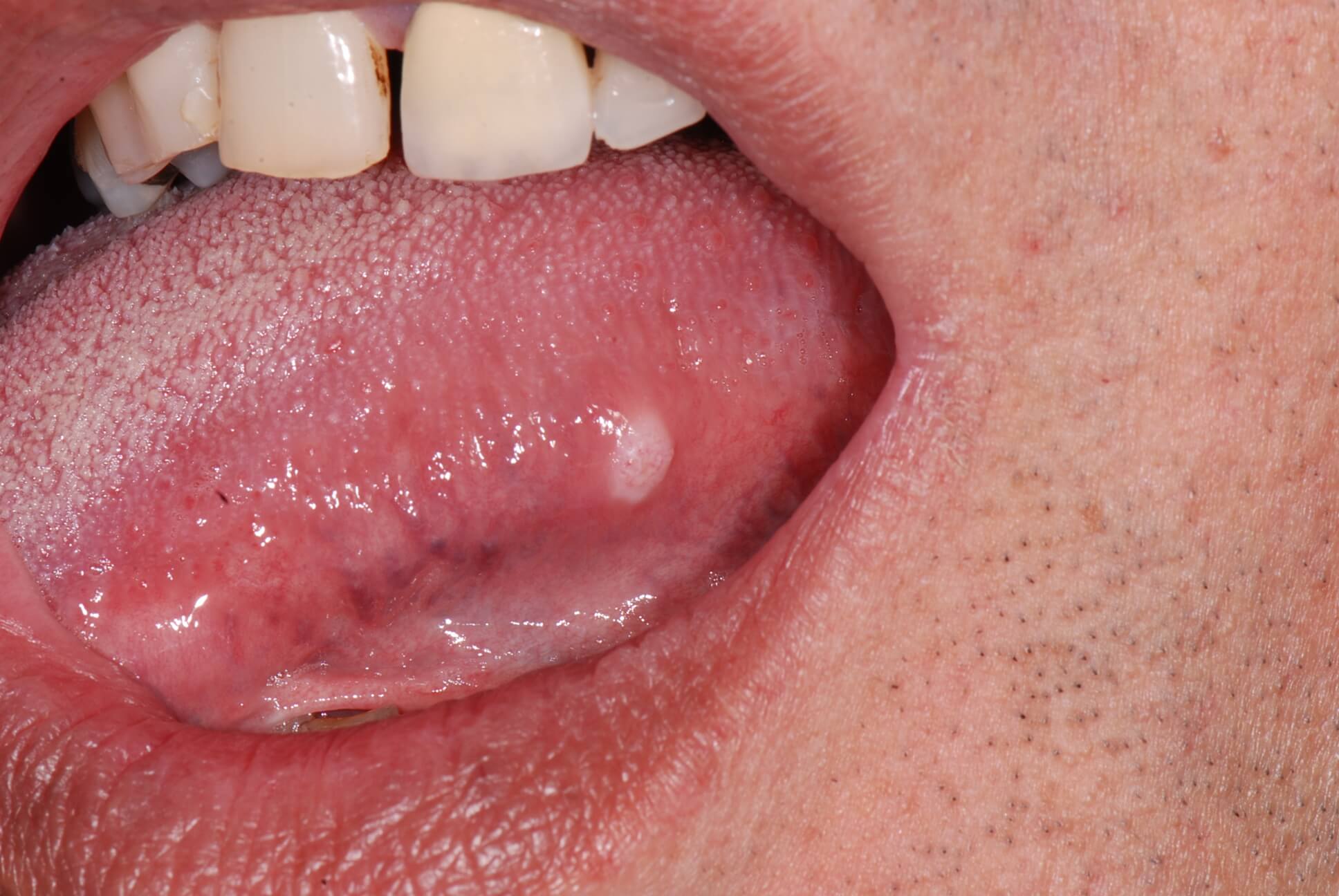Tongue cancer