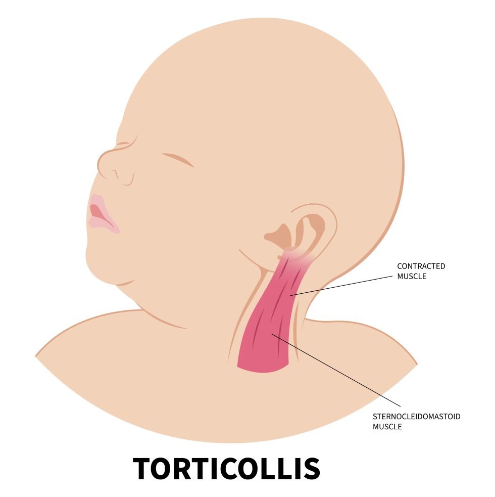 Torticollis