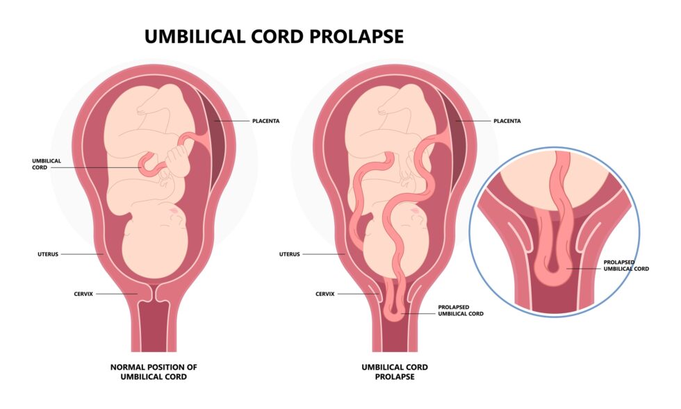 Umbilical cord prolapse