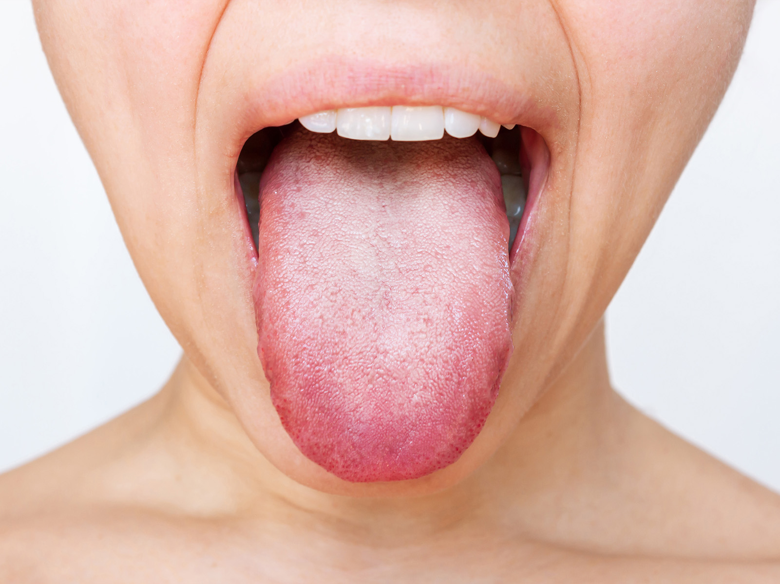 White Tongue