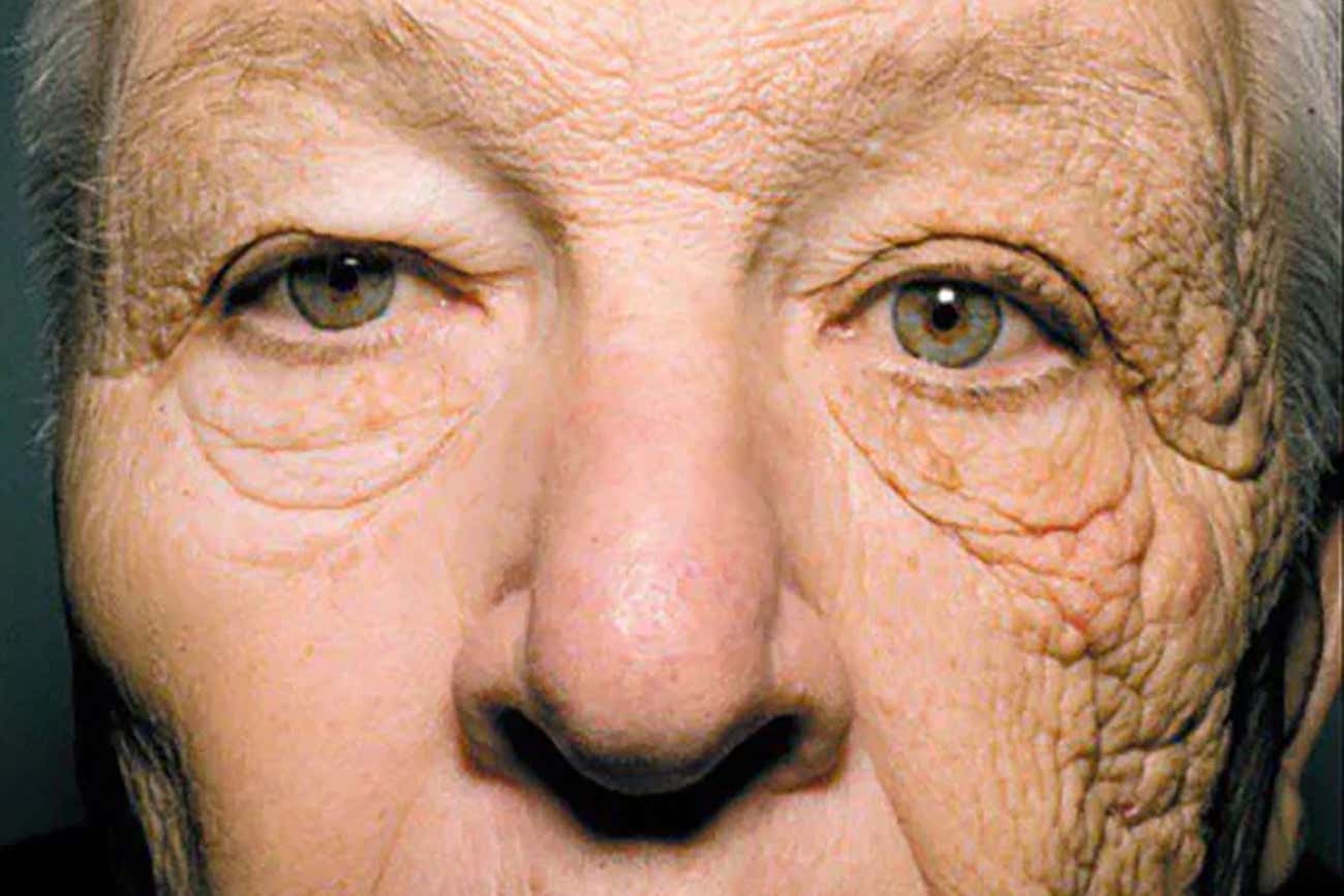 Wrinkles