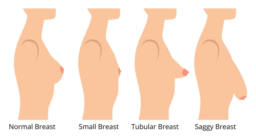 breasts
