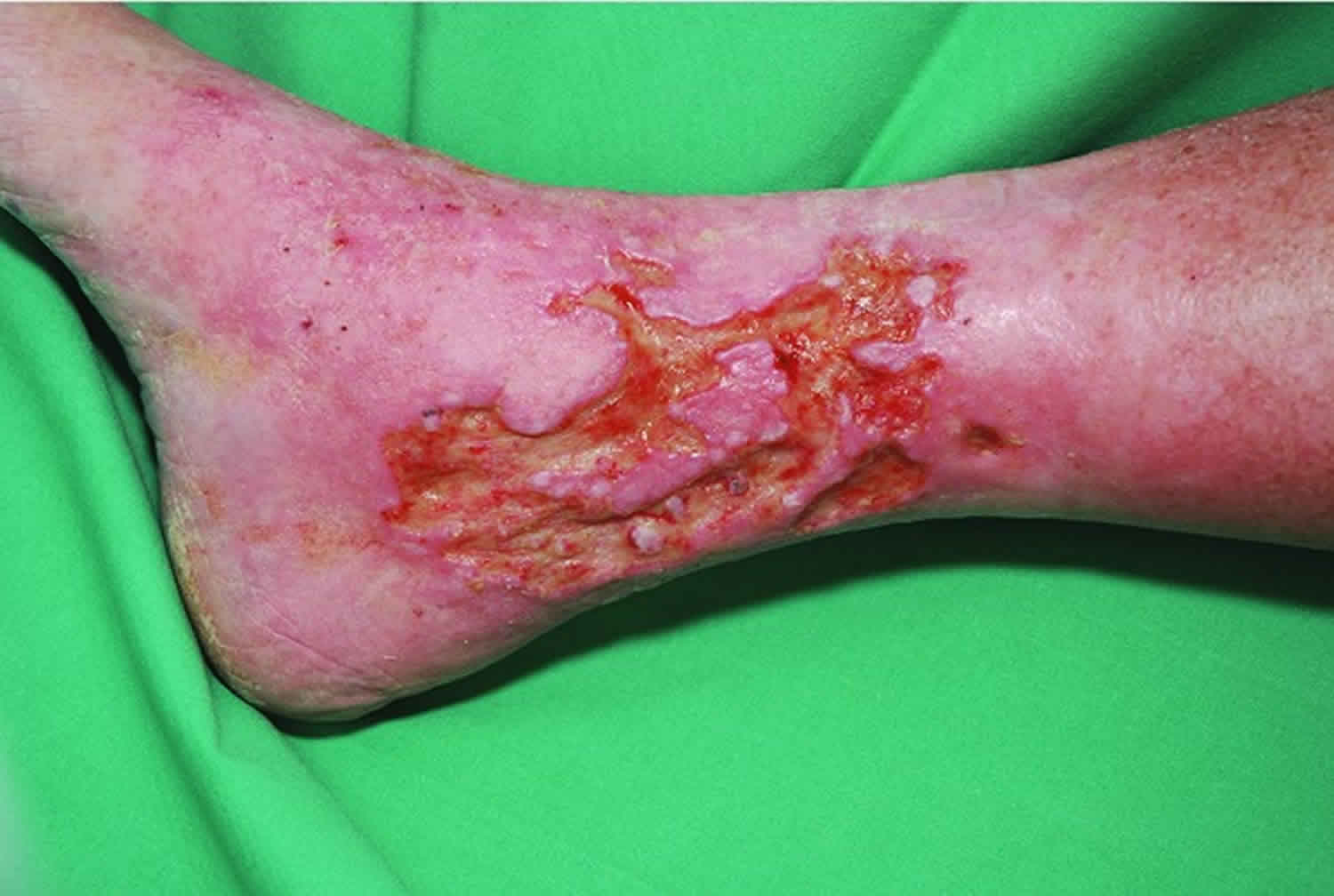 venous ulcer