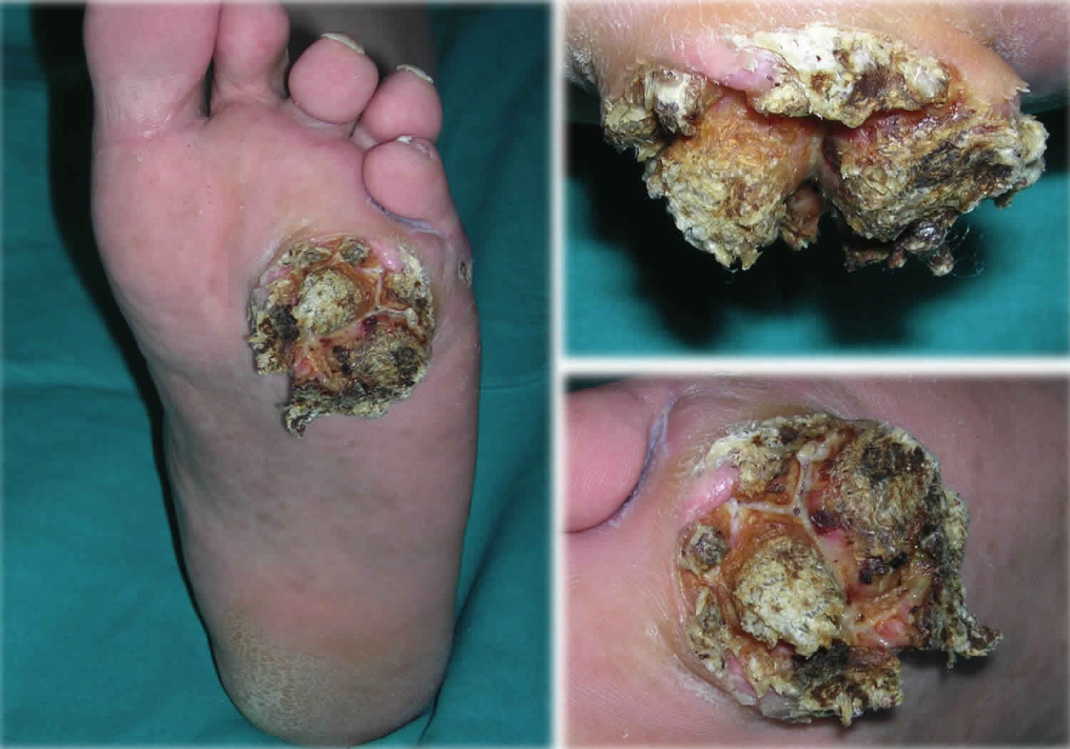 verrucous carcinoma