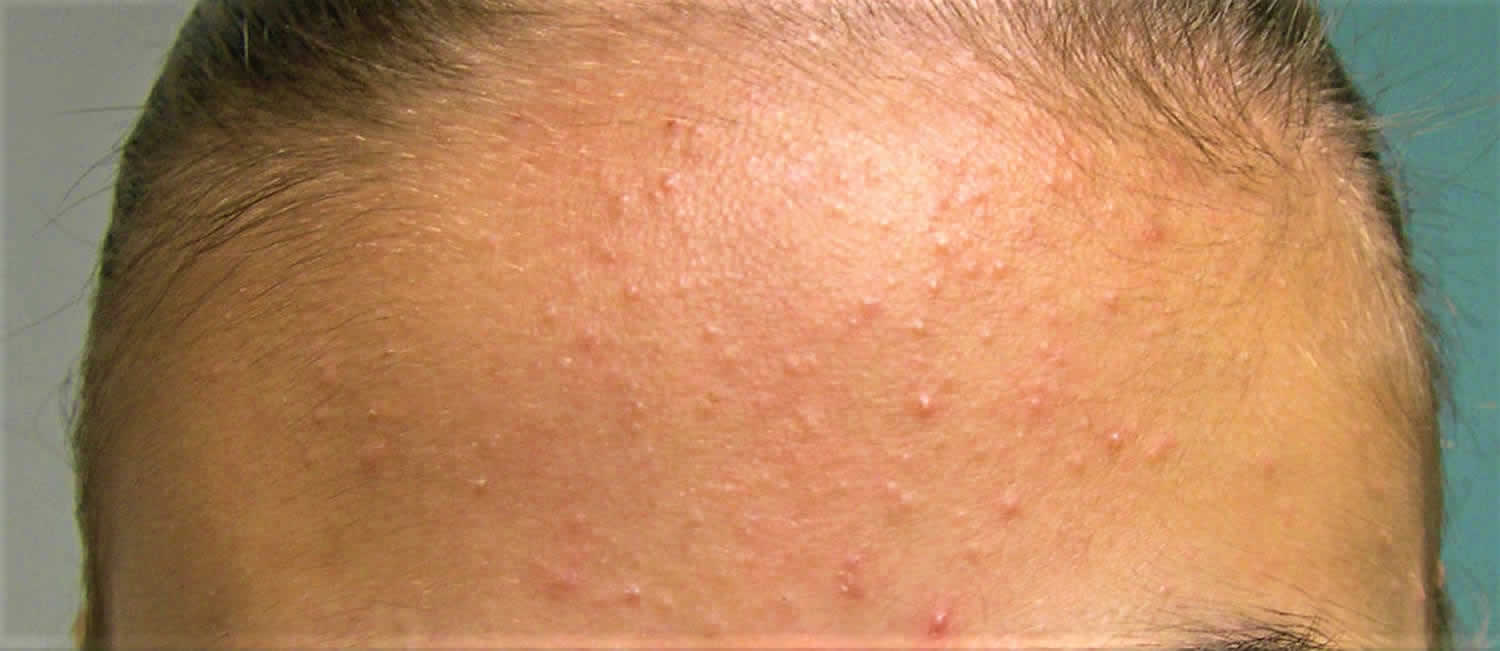 whiteheads